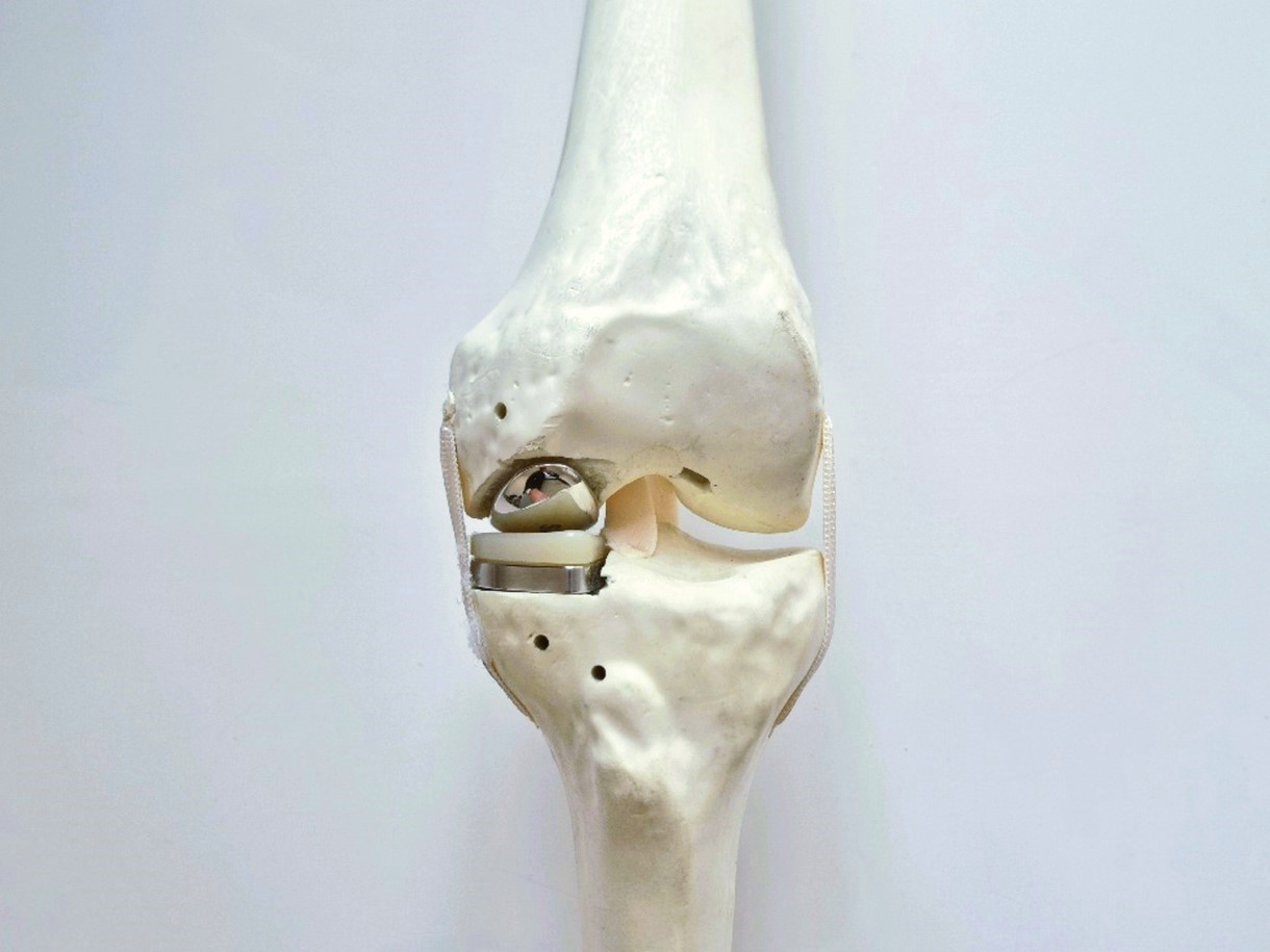 Knieprothese - Dr. Ewald Timmel - Orthopde Wien - Kniespezialist