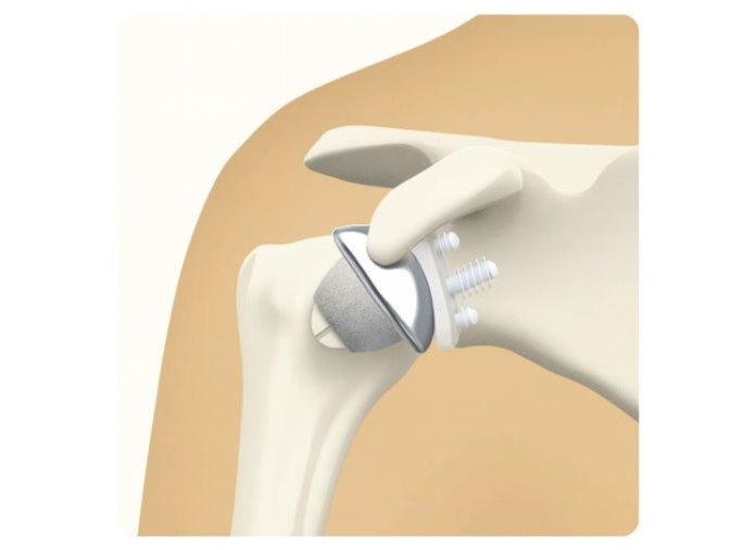 schaftfreier humeruskopfersatz von dr.timmel von ortho-timmel.at