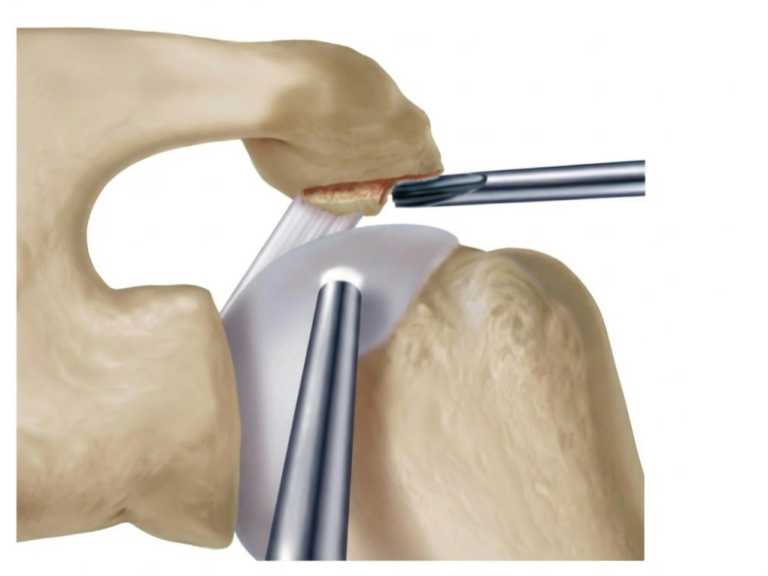 subakromiale dekompression von dr. timmel von ortho-timmel.at