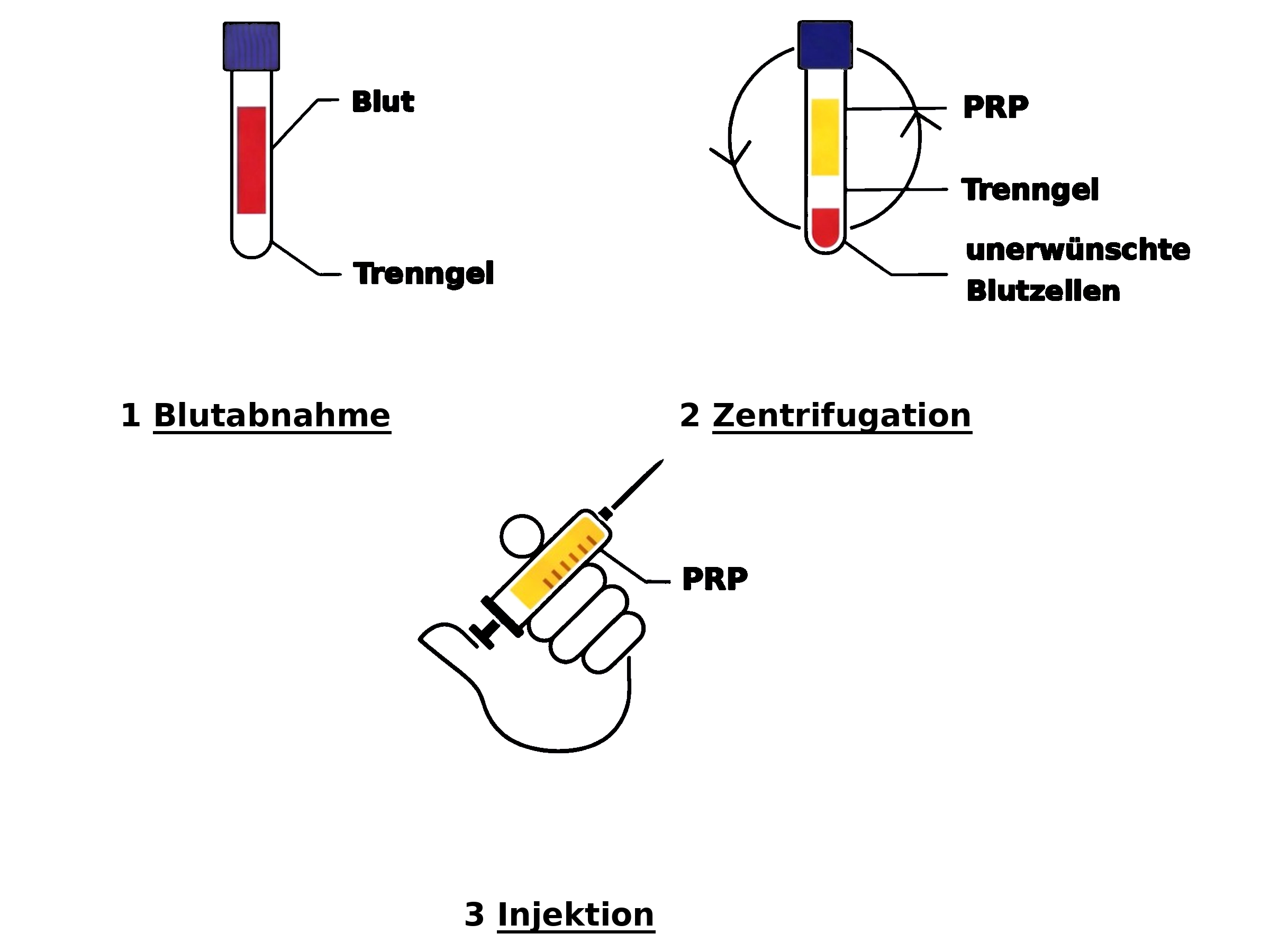 PRP- Therapie Anleitung | Wien | ortho-timmel.at